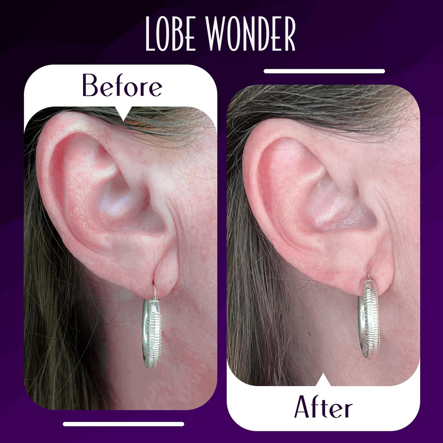Lobe Wonder Ear Lobe Support Patch - Alternate angle